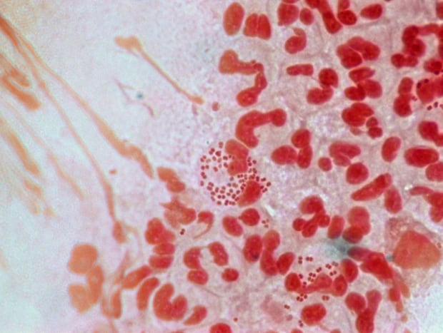 Drug Resistant Gonorrhea 2013010