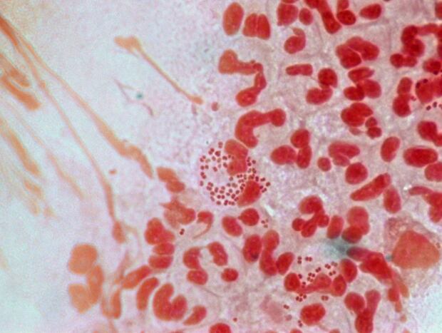Drug Resistant Gonorrhea 2013010