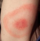 The distinctive 'bullseye' rash sometimes, but not always, shows Lyme disease infection.