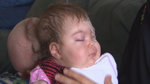 Baby Ebar was born in Winnipeg with a rare birth defect that left her brain outside her skull
