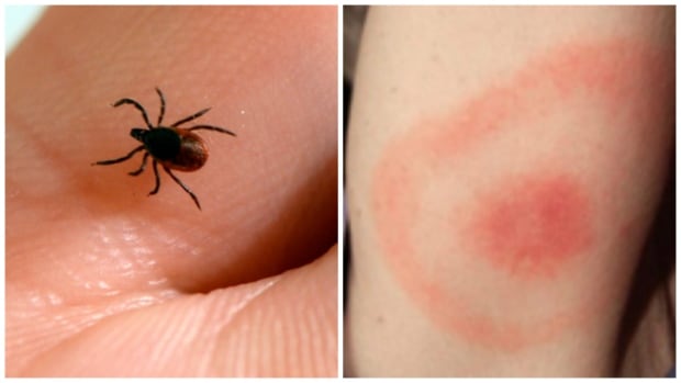 Madre, hijo de ir a Alemania para última hora de variante de la enfermedad de Lyme de la terapia de la CBC.ca 2 Tick bite