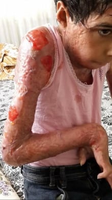 Maryam suffered burns to 80 per cent of her body after bombing in Syria
