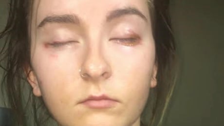 Fort Saskatchewan teenager, Alexis Bizuk says she had a severe allergic reaction to eyelash extensions applied by an untrained technician. Eyelash extensions