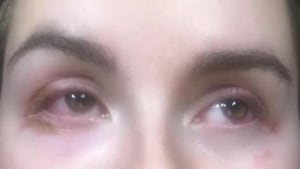 eyelash complaint