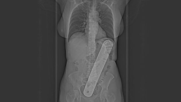 'It felt like I had been stabbed,' Says Patient Left with 33-cm Metal Plate Inside After Surgery 'It felt like I had been stabbed,' Says Patient Left with 33-cm Metal Plate Inside After Surgery. Image: Radio-Canada