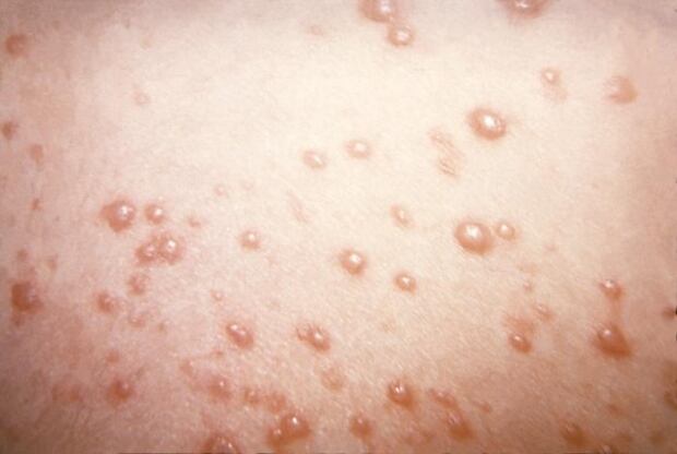 Shingles