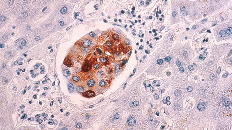 The malignant breast cancer cells metastasized to the liver. Scientists have discovered the signaling process that causes densely packed cancer cells to break away from a tumor and spread the disease elsewhere in the body.