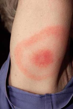 tick bite rash bulls-eye lyme disease symptoms