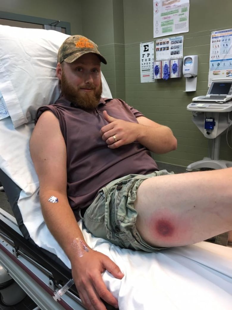 Brown Recluse Spider Bites On Arm