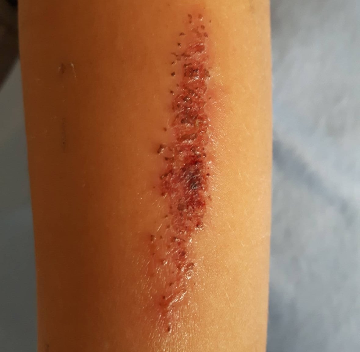 Campbellton parent warns of harmful 'eraser challenge' CBC News