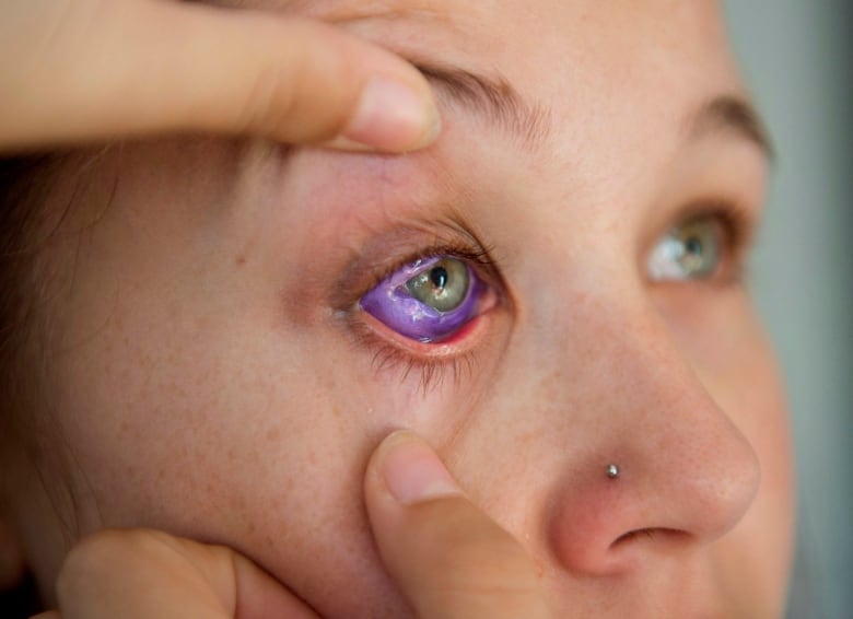 Sclera Tattoos (Eye Tattoos) - Are They Worth The Risk? | Focus Clinics