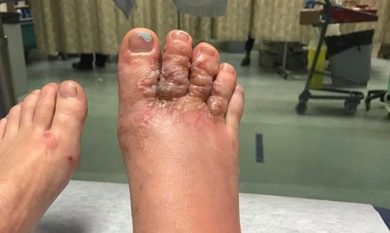 hookworm rash