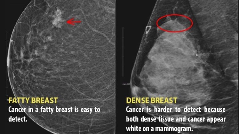 Mammography in Breast Cancer: Background, X-ray Mammography, Ultrasound