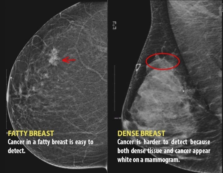 What Having Dense Breasts Means For Your Health