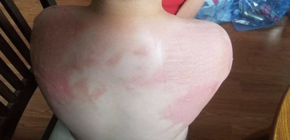 Why One Boy S Bad Sunburn Has Mount Pearl Making Changes To A Summer Camp Policy Cbc News