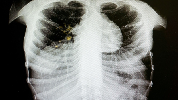 Inuit leaders, MPs urge action on TB elimination as federal budget nears; A case of tuberculosis has been confirmed in one patient connected to a school in Antigonish, N\.S\., but public health officials say the threat to the general public is low\.