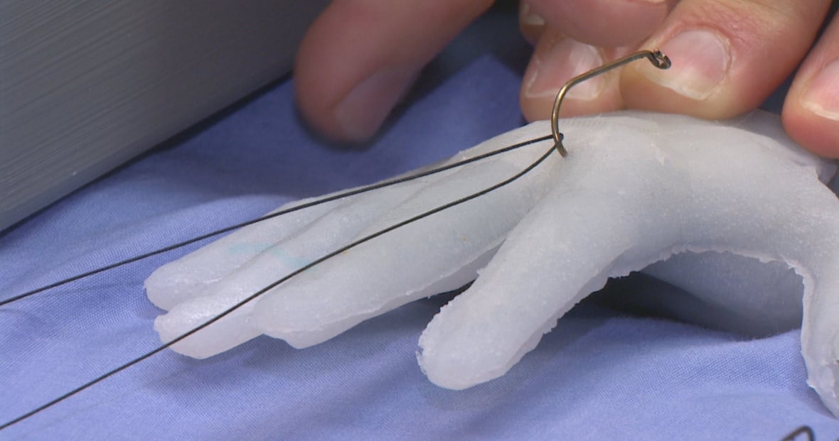 Dr. Christopher Patey is his name, removing fish hooks is his game