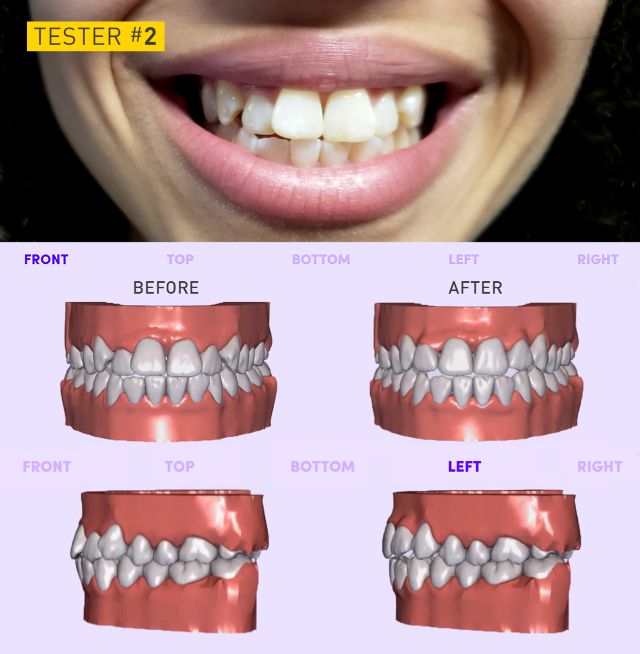 Invisalign Before and After: Kim's Journey With Clear Aligners