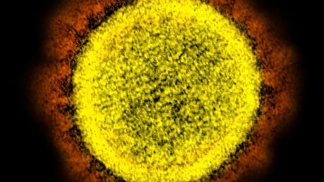 Alberta health officials investigating 2 workplace outbreaks of P1 coronavirus variant