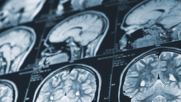 Patients ask Holt to intervene in N.B.'s mystery brain illness investigation