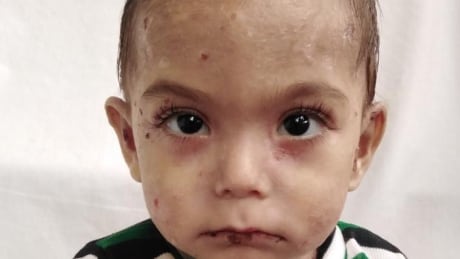 One-year-old Tim Alahmad suffers from butterfly syndrome, a rare genetic condition which makes skin so fragile to blisters, and sores, breeding grounds for infection. Baby Tim
