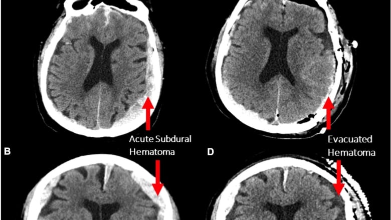 Does life flash before our eyes as we die? A Vancouver man's brain scan ...