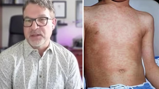 A composite photos of a man with glasses speaking on the left, and a child's body with measles on the right.