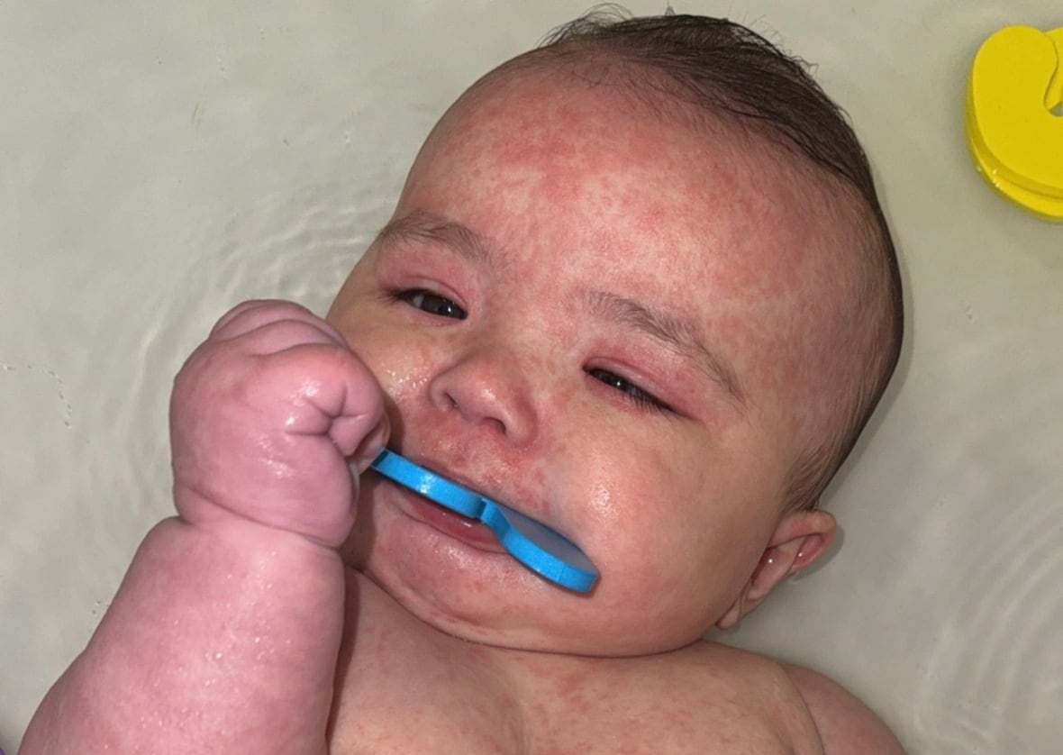A baby with inflamed skin with a blue teething toy in its mouth