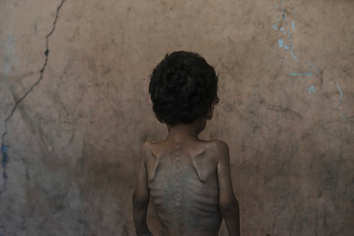 A young stands topless against a wall showing his thin body and bones under his skin.