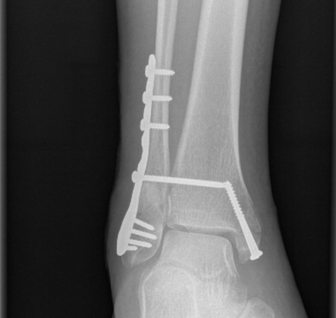 xray of ankle bone secured with metal plates and screws