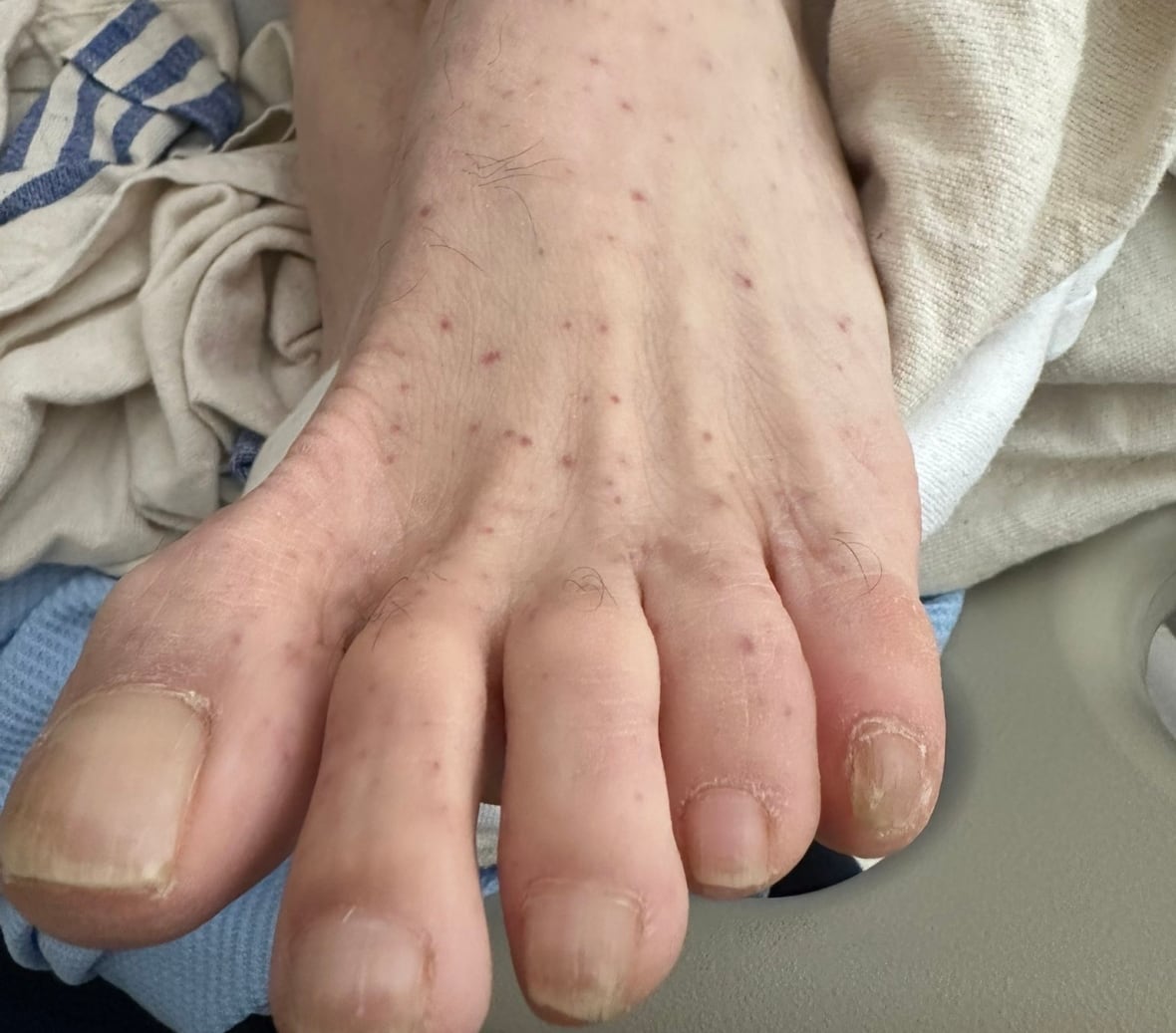 Foot with spotted rash