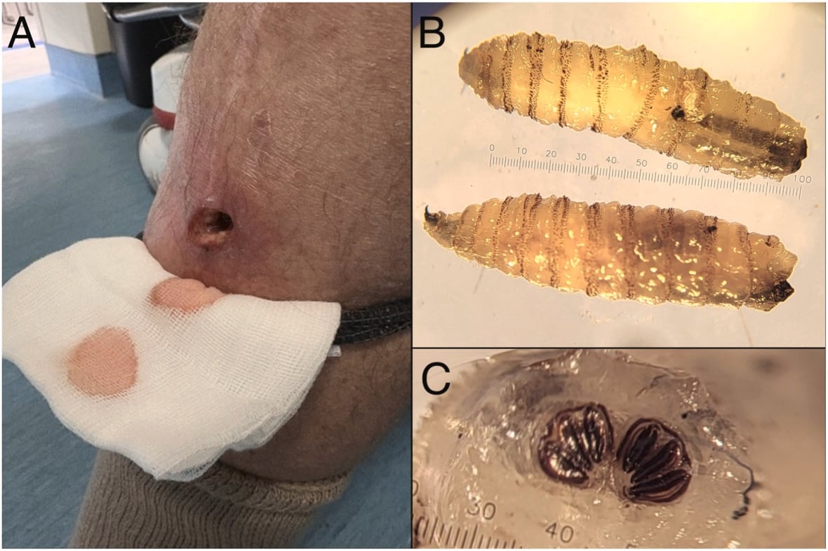 On the left, an open wound on the leg of a man with a piece of gauze held below. On the upper right, two larvae and a close-up of the head of one of the larvae on the bottom right.