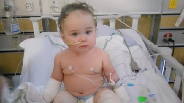 A Grande Prairie girl, identified in a court decision as KB, had to undergo a quadruple amputation as a baby due to complications of a bacterial infection. A baby girl sits on a hospital bed with bandages on all four limbs.