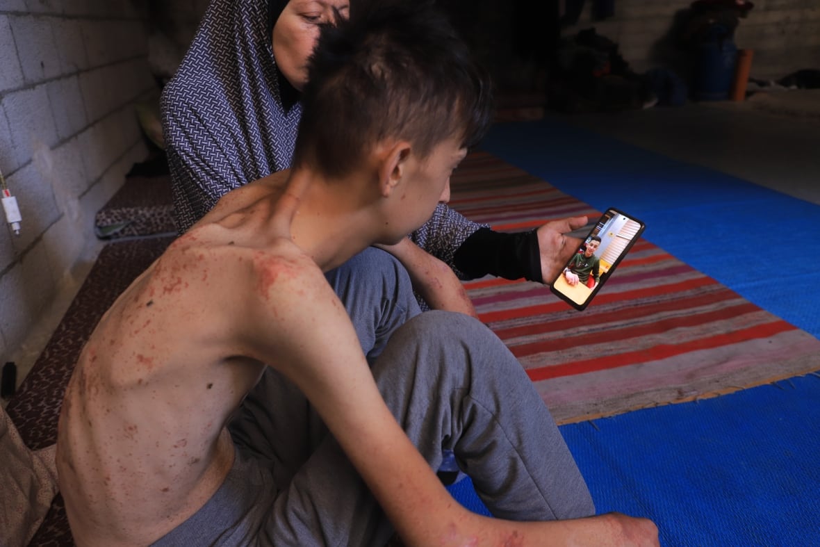 Ahmed Ali Patnigi's skin is covered with rash, highlighting the blood circulation programs caused by food deficiency.