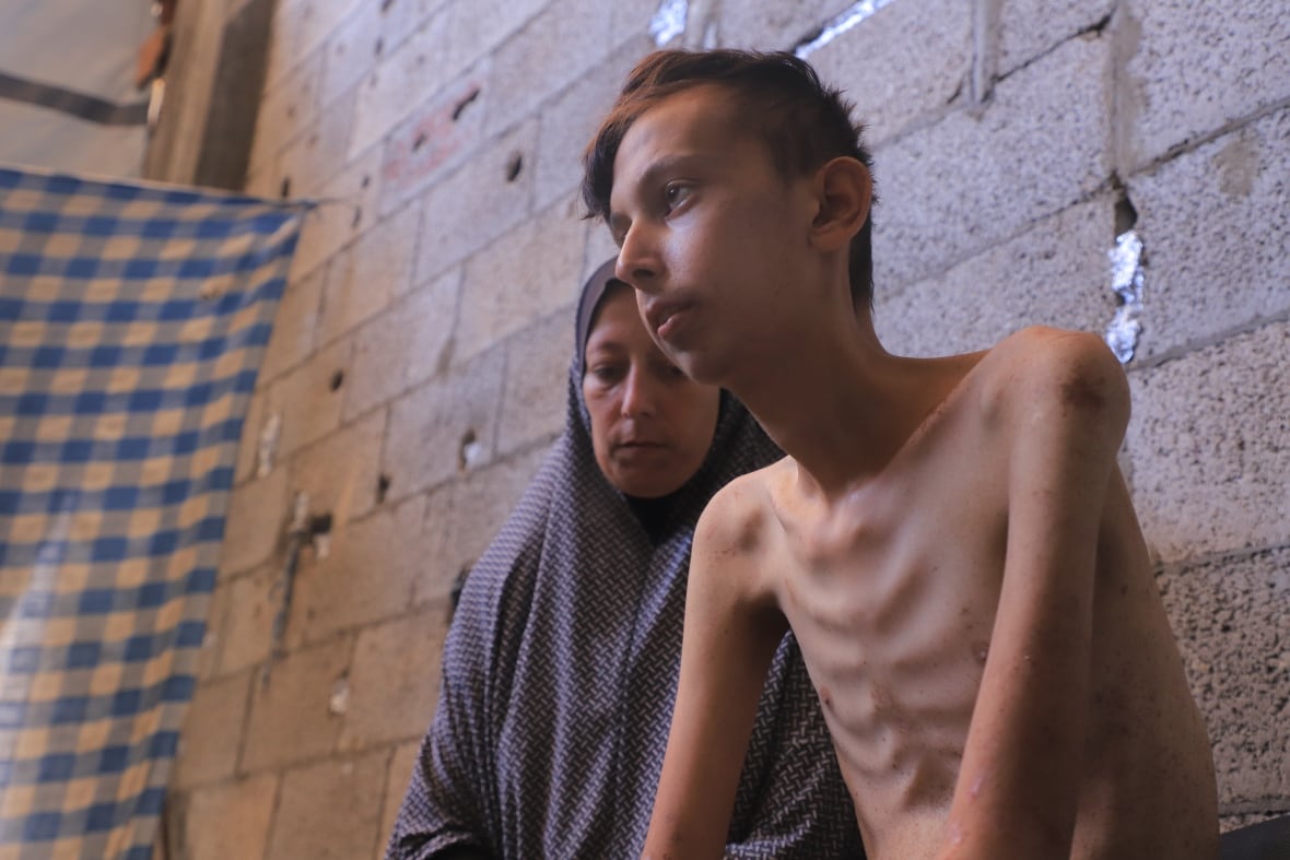 Ahmed Ali Al Batniji, 17, sits with his mother in their makeshift shelter in Gaza City. The teenager suffered from celiac disease which made his body intolerant to gluten. After Israel's seige of the enclave and halt to food deliveries in March, most of the food he relied on disappeared from markets.