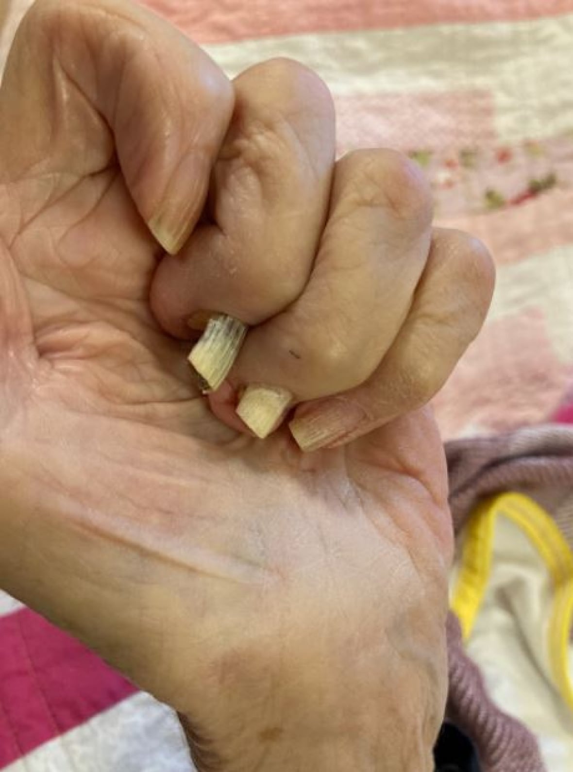 A hand with cracked and damaged fingernails.