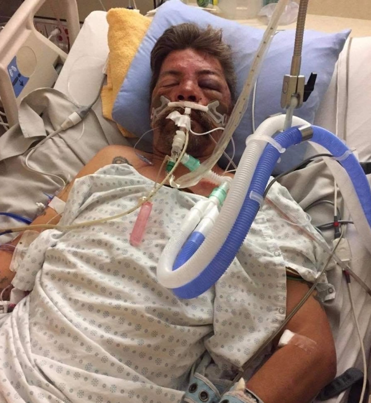 A man heavily injured in a hospital room.