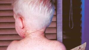 hi-measles-852