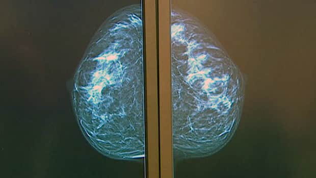 Preventive double mastectomy CBC.ca