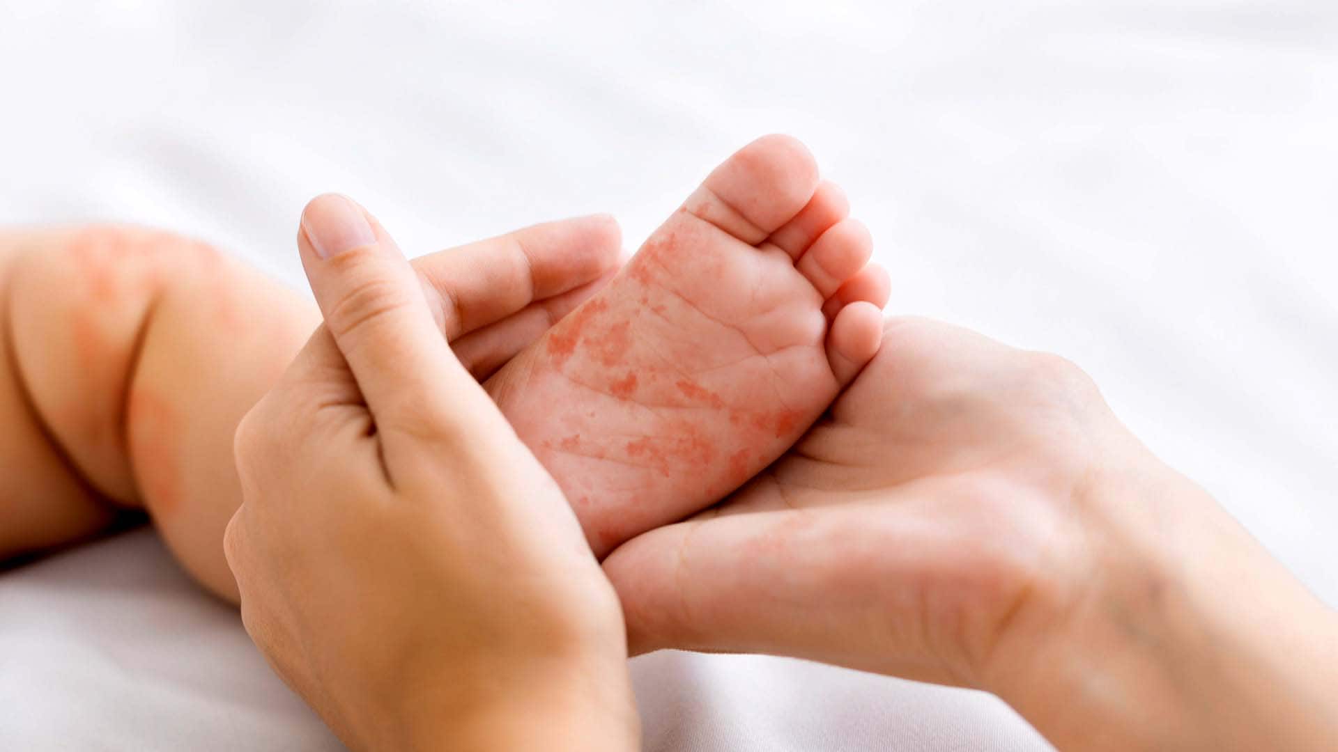 Nearly 3 in 4 infants live where low vaccine coverage drives measles outbreaks: UN Nearly 3 in 4 infants live where low vaccine coverage drives measles outbreaks: UN