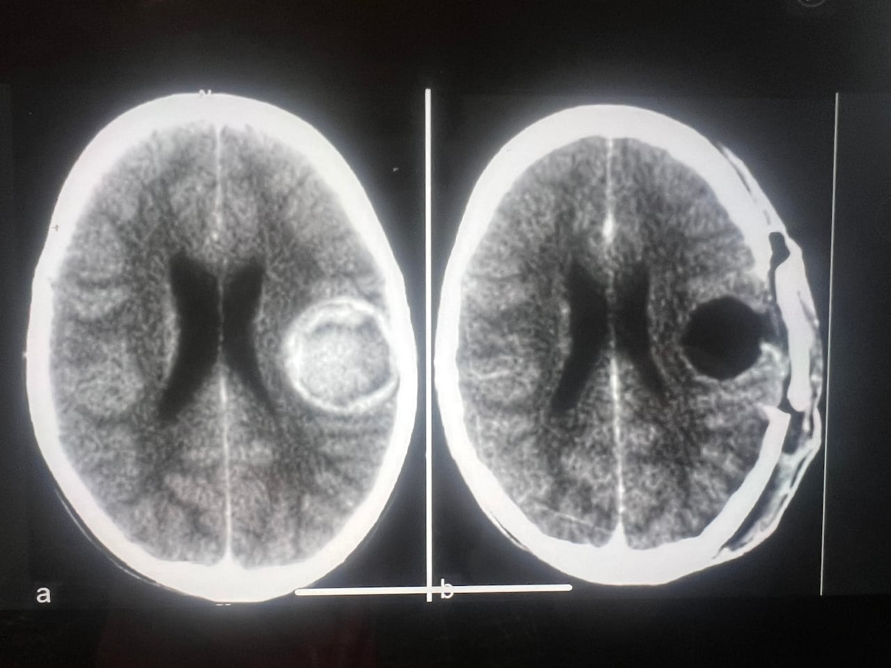 This brain scan image shows Mark Foster's skull before and after life-saving surgery.