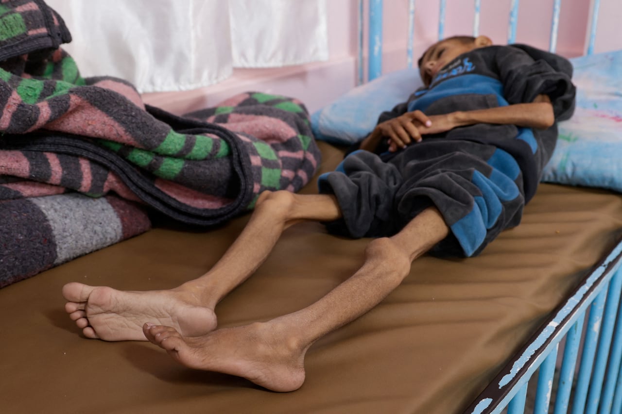 A young emaciated boy lied on a bed.