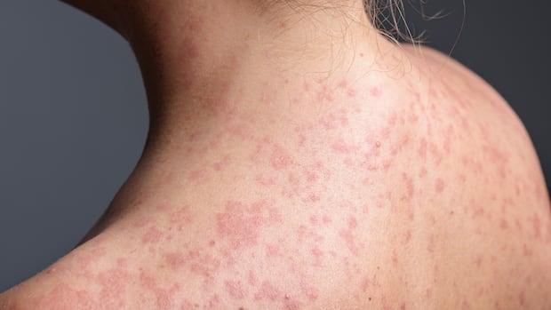 A,Woman,With,A,Red,,Spotty,Rash,On,Her,Upper shoulders