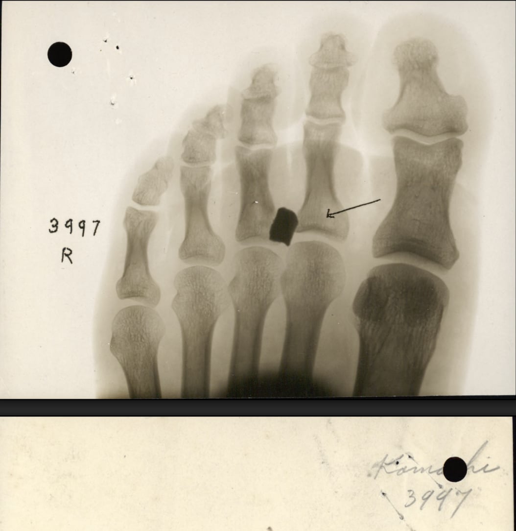 An x-ray from retired Private Otoji Kamachi's first world war military personnel records that appear to show shrapnel in his foot. 