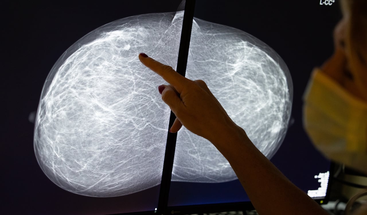 Mammographie d'un sein sur un écran dans une clinique du sein.