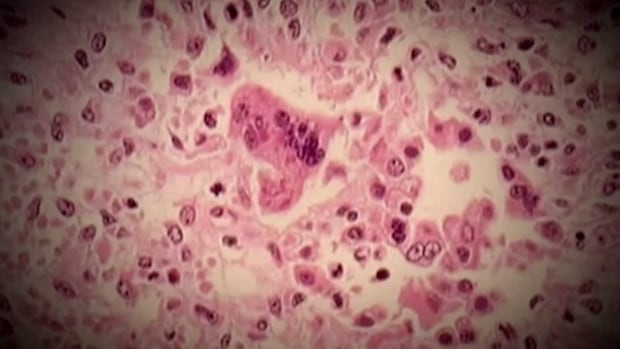 Measles exposures spike in northeast B.C., with another 29 suspected cases