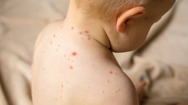 A baby has a red skin rash on its back. A baby has a red rash on its back.